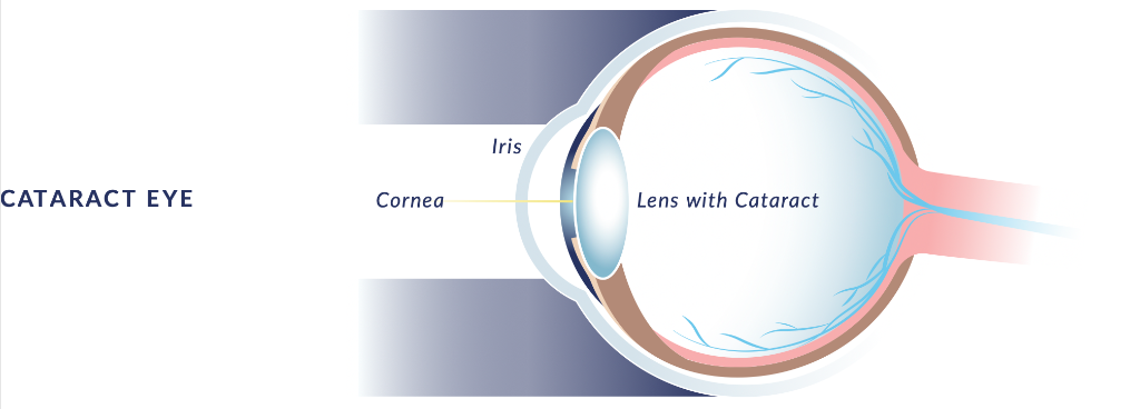 Cataract Eye Diagram