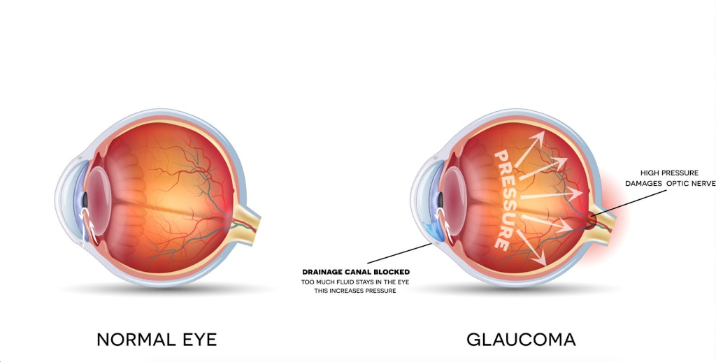 Normal Eye vs Glaucoma Diagram