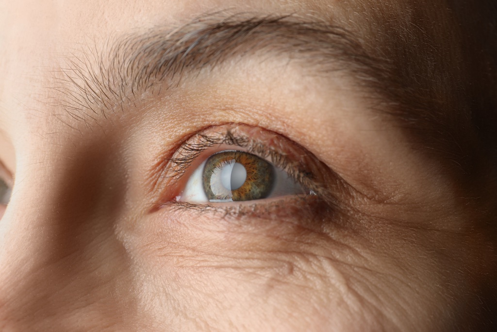 Cataracts