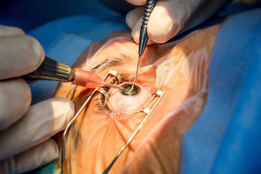 Cataract Surgery