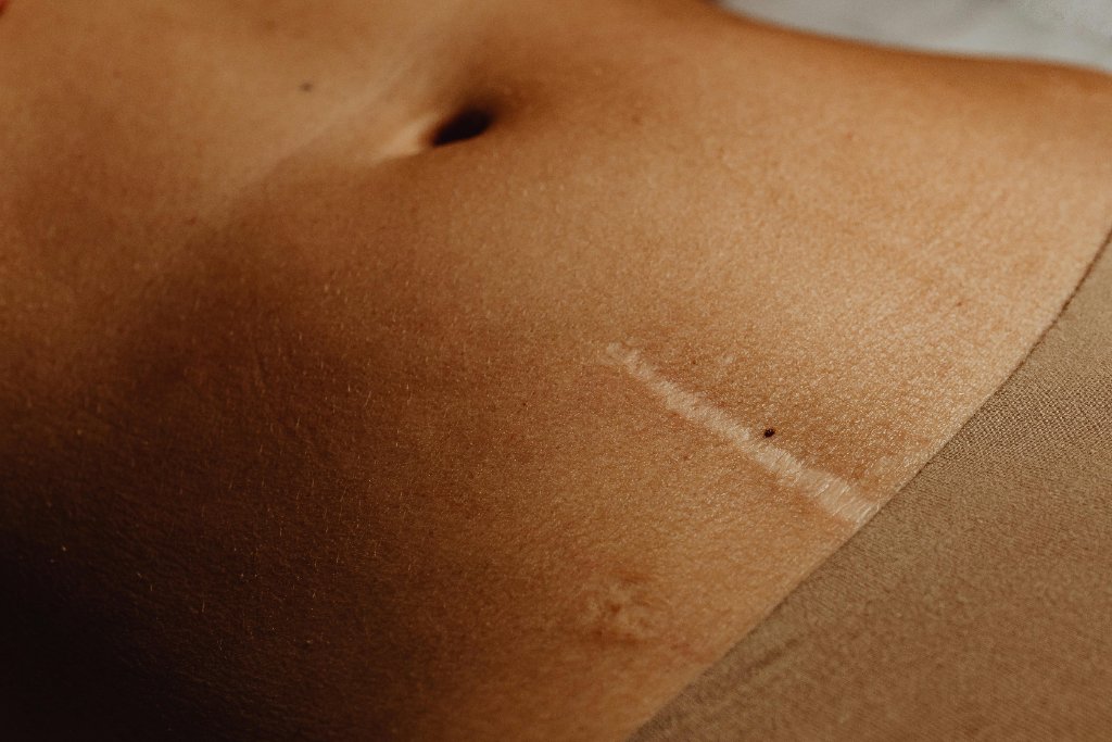 Stretch Marks