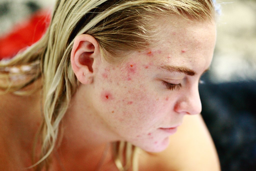 Acne Marks