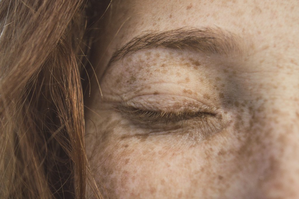 Pigmentation & Melasma
