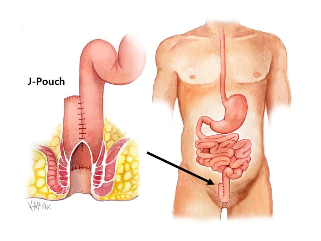 J-pouch anatomy