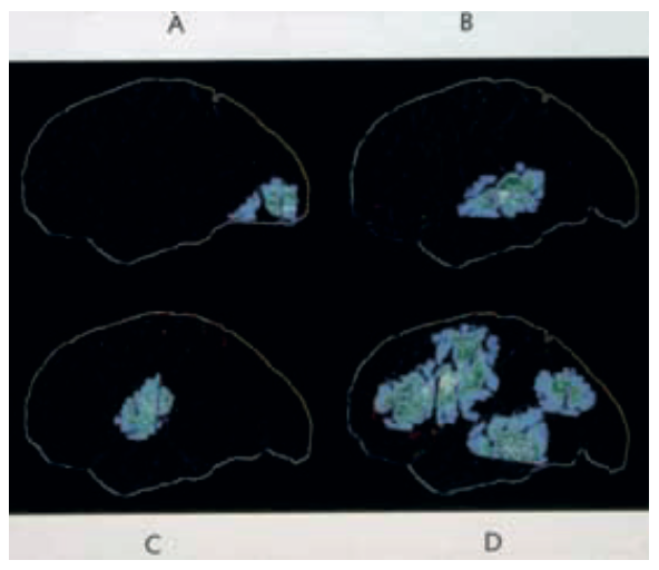 Fig 2 – Brain activity from single word processing