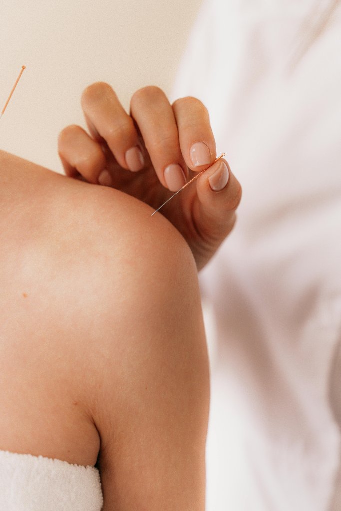 Dry Needling (IMS) behandling hos Kiropraktorkameratene