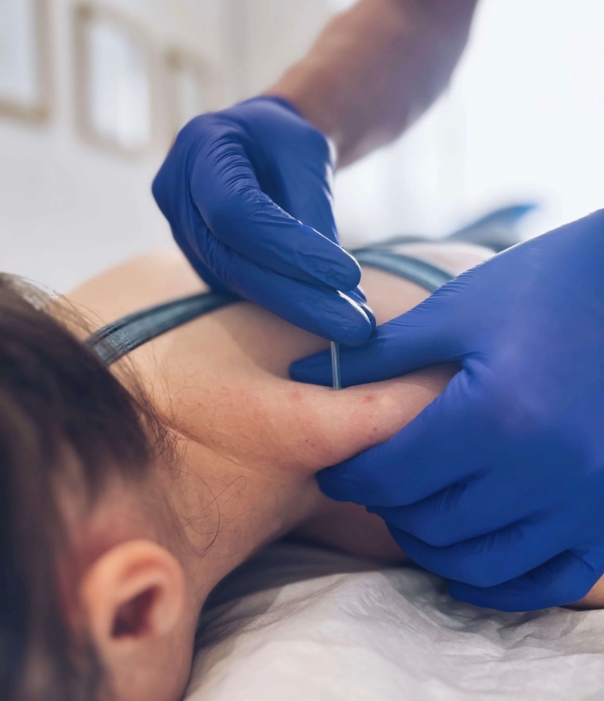 Dry needling neck treatment