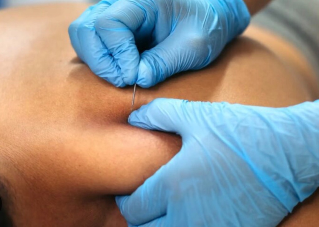 Dry needling treatment close up