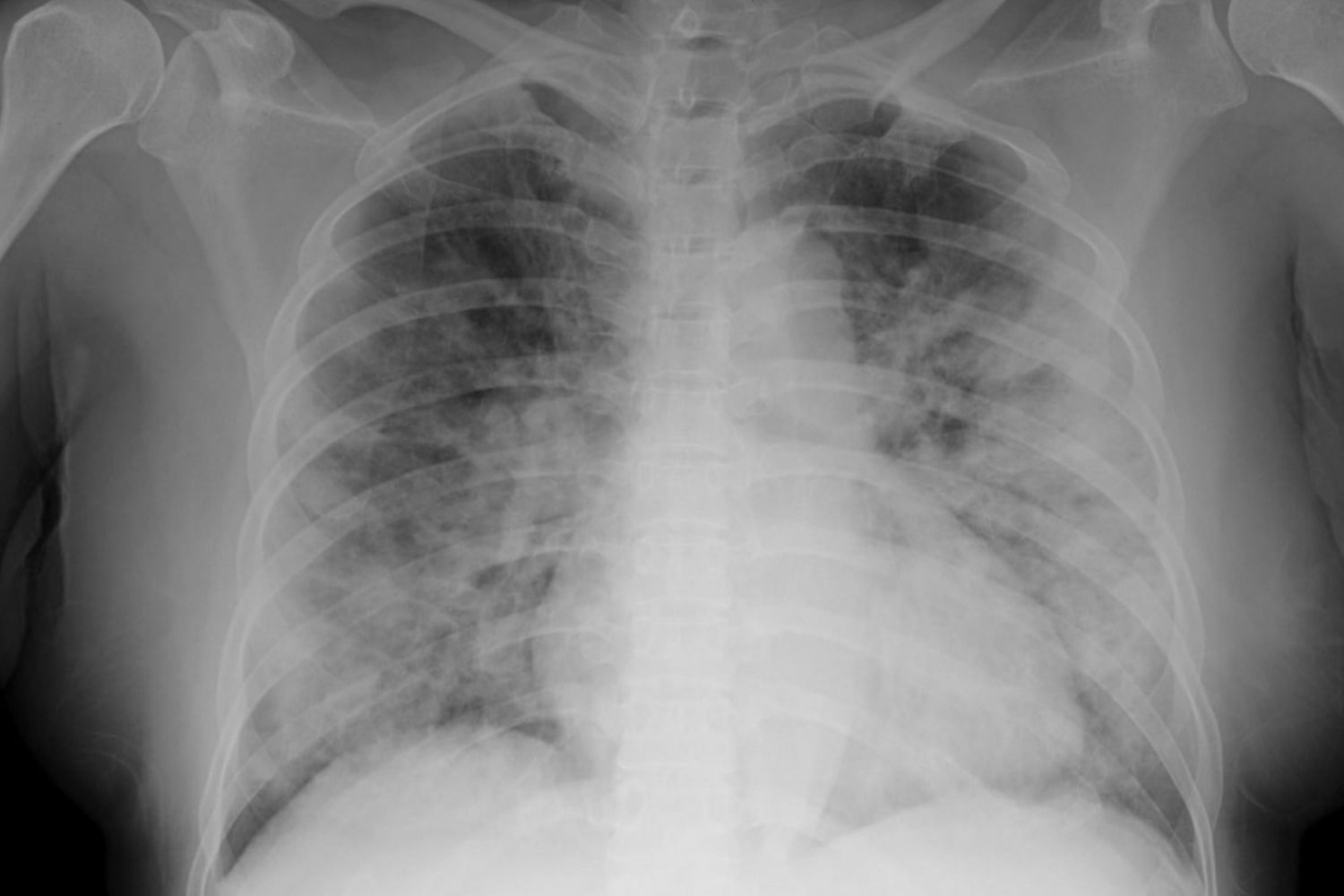 Chest X-ray