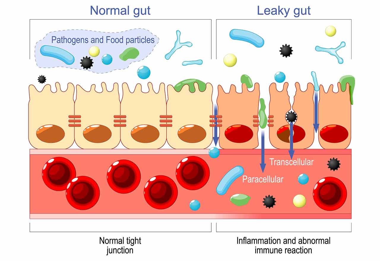 Comparison of normal gut lining and leaky gut permeability