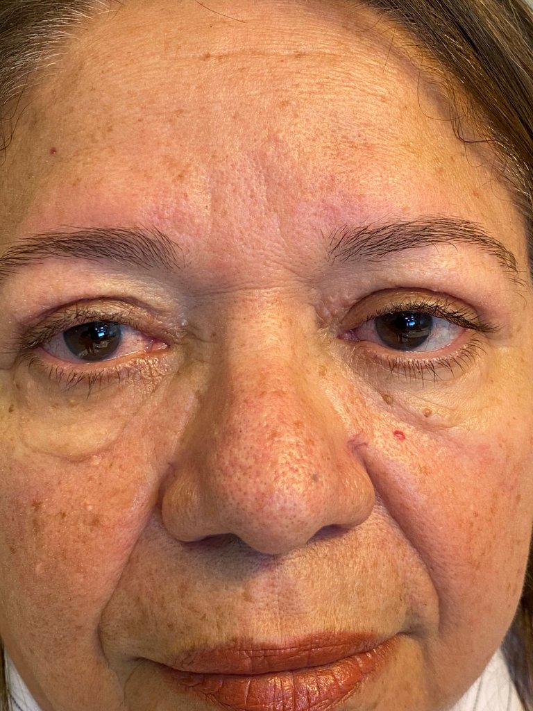 Paciente Helena - Depois da Blefaroplastia