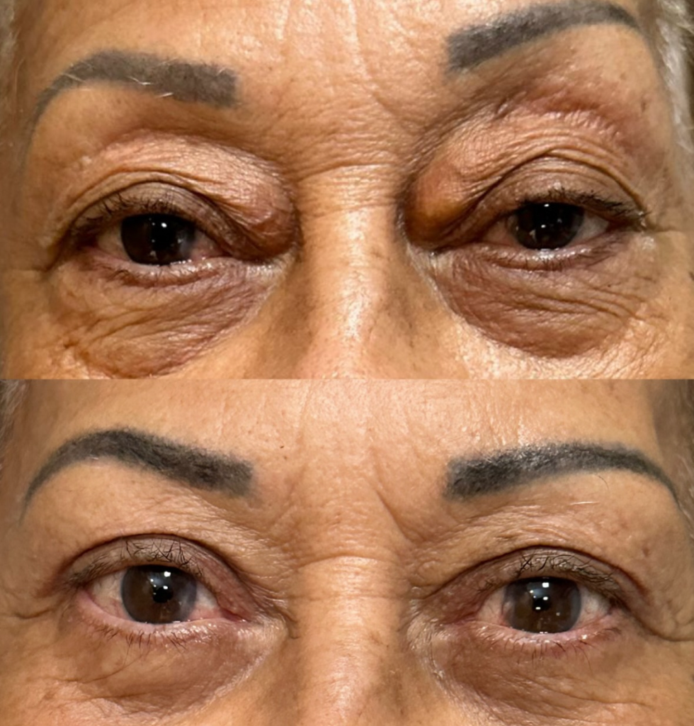 Resultado de blefaroplastia - imagem 2 de antes e depois do procedimento
