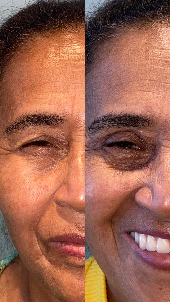 Resultado de blefaroplastia - imagem 4 de antes e depois do procedimento