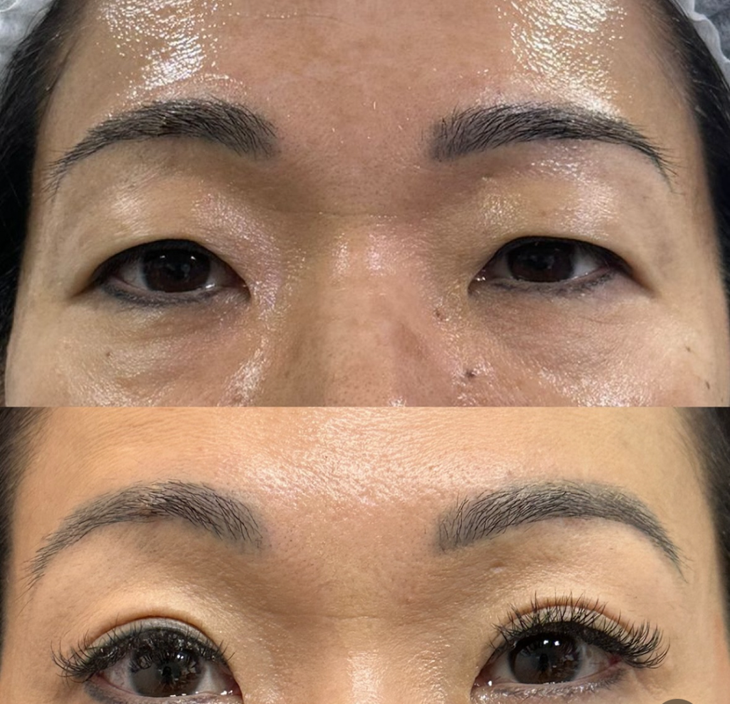 Resultado de blefaroplastia - imagem 1 de antes e depois do procedimento