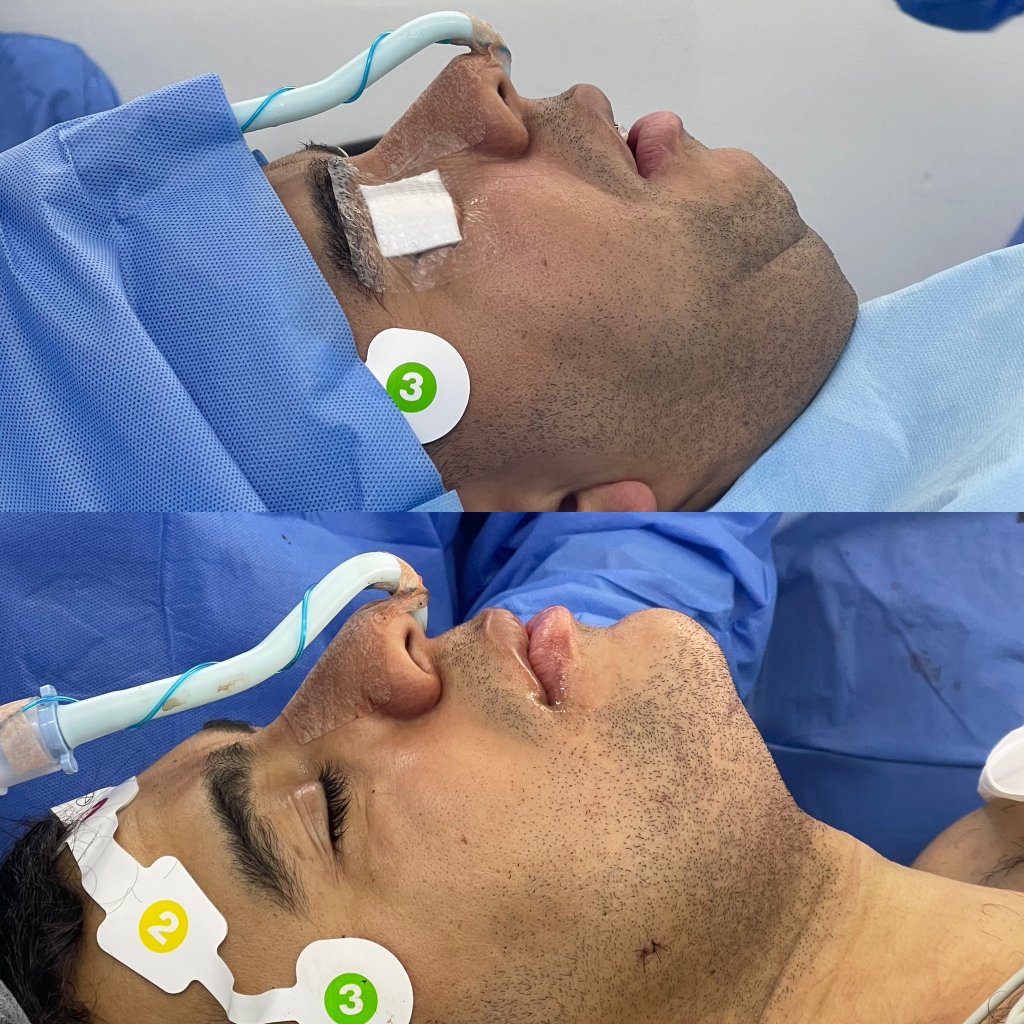 Cervicoplastia - tratamento estético na Clínica Espaço Hévolus