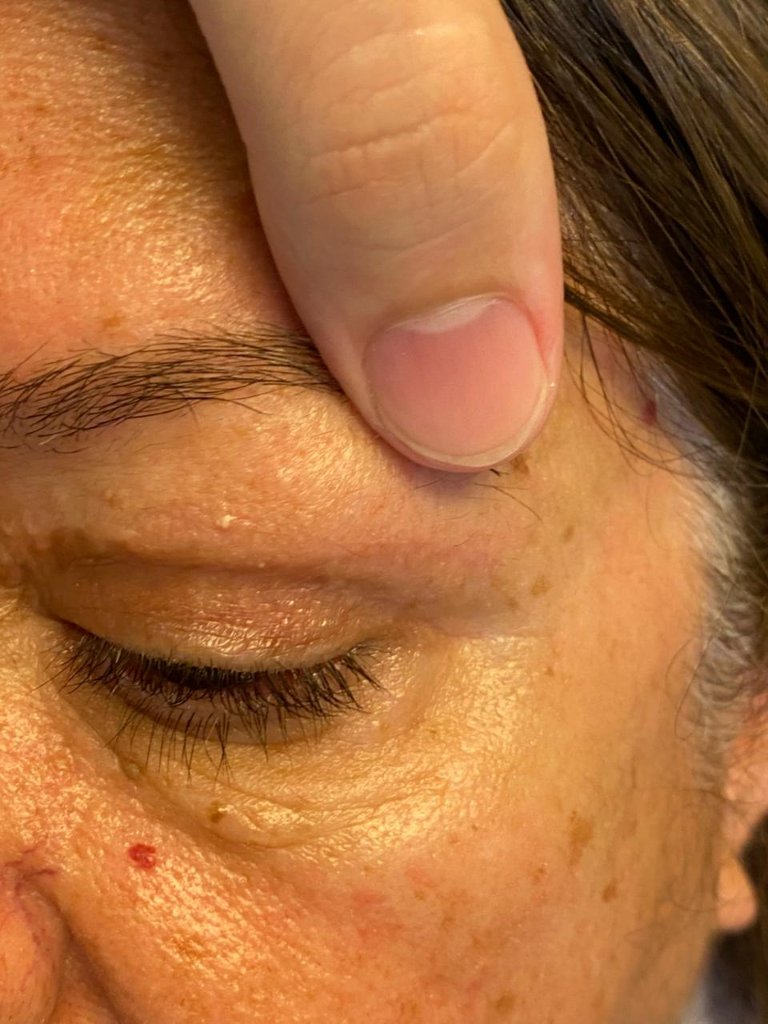 Cicatrização após 5 meses de Blefaroplastia