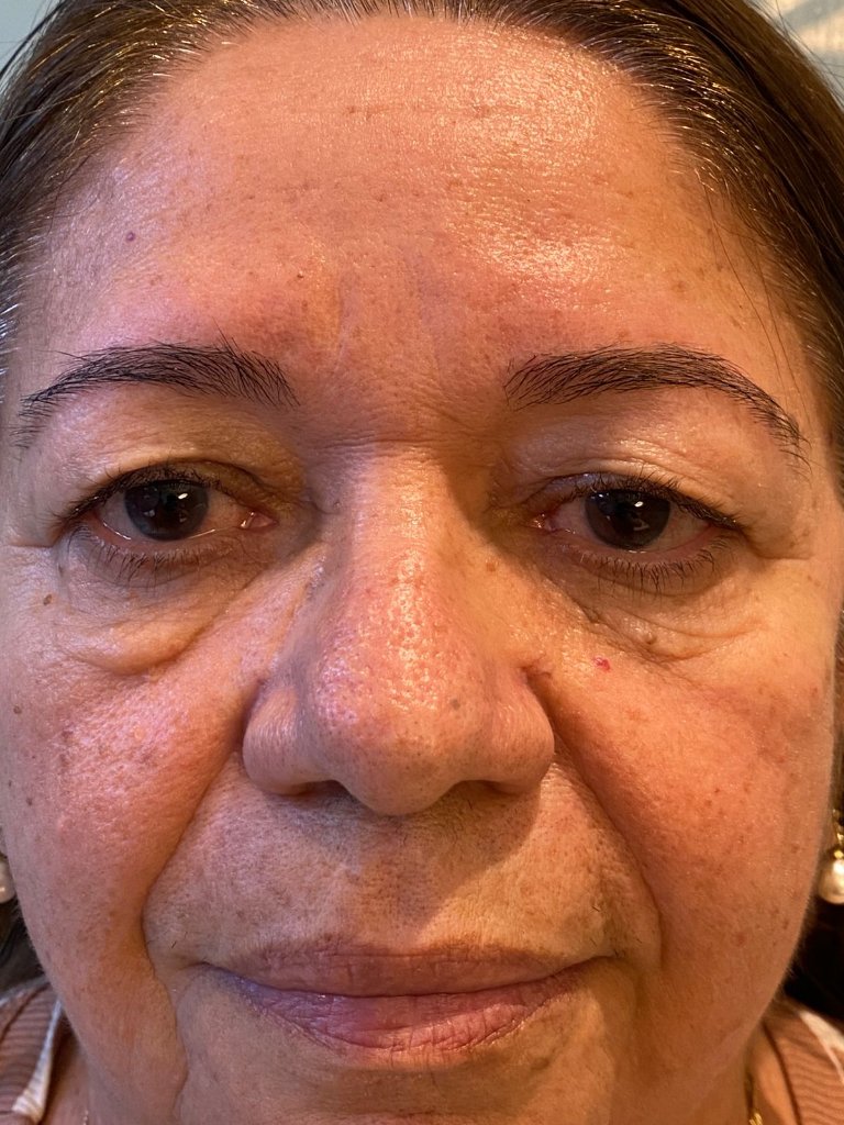 Paciente Helena - Antes da Blefaroplastia