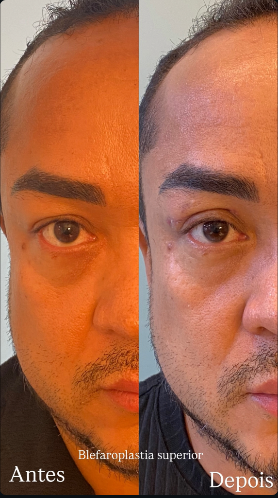 Blefaroplastia & Cirurgias Faciais - tratamento estético na Clínica Espaço Hévolus