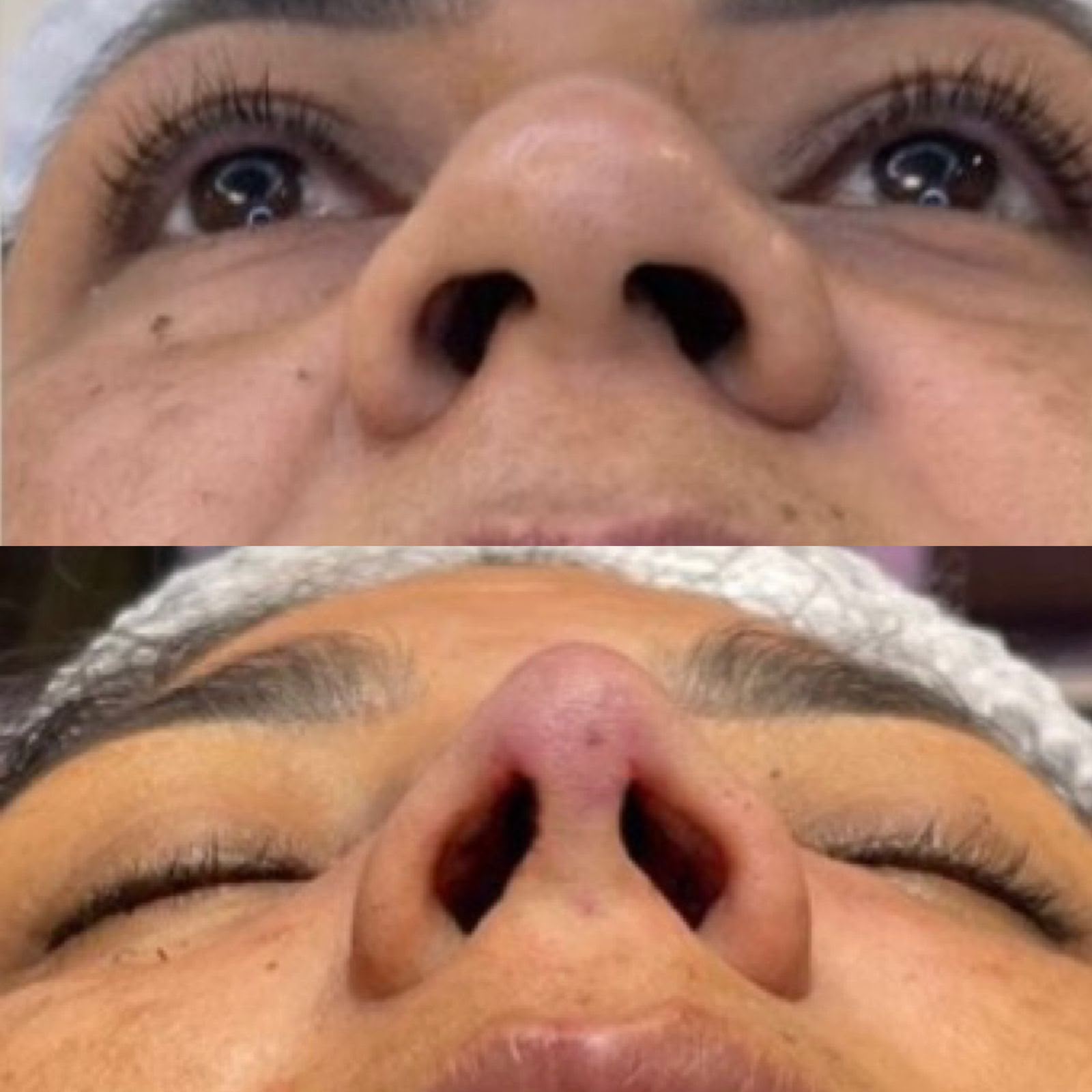 Resultado Rinoplastia 1