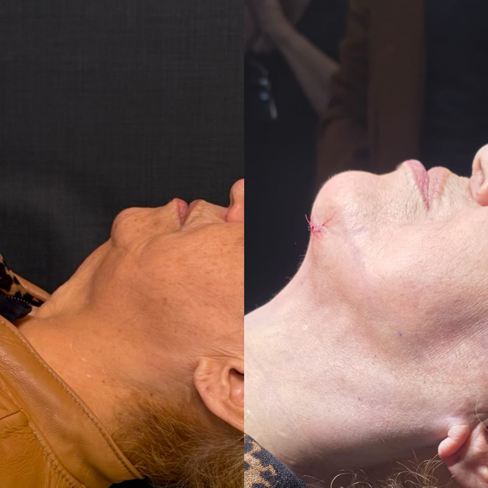Antes e Depois - Lipo de Papada