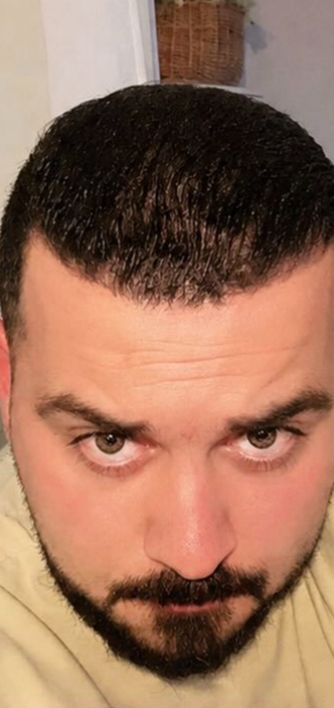 After — Hairline Reconstruction