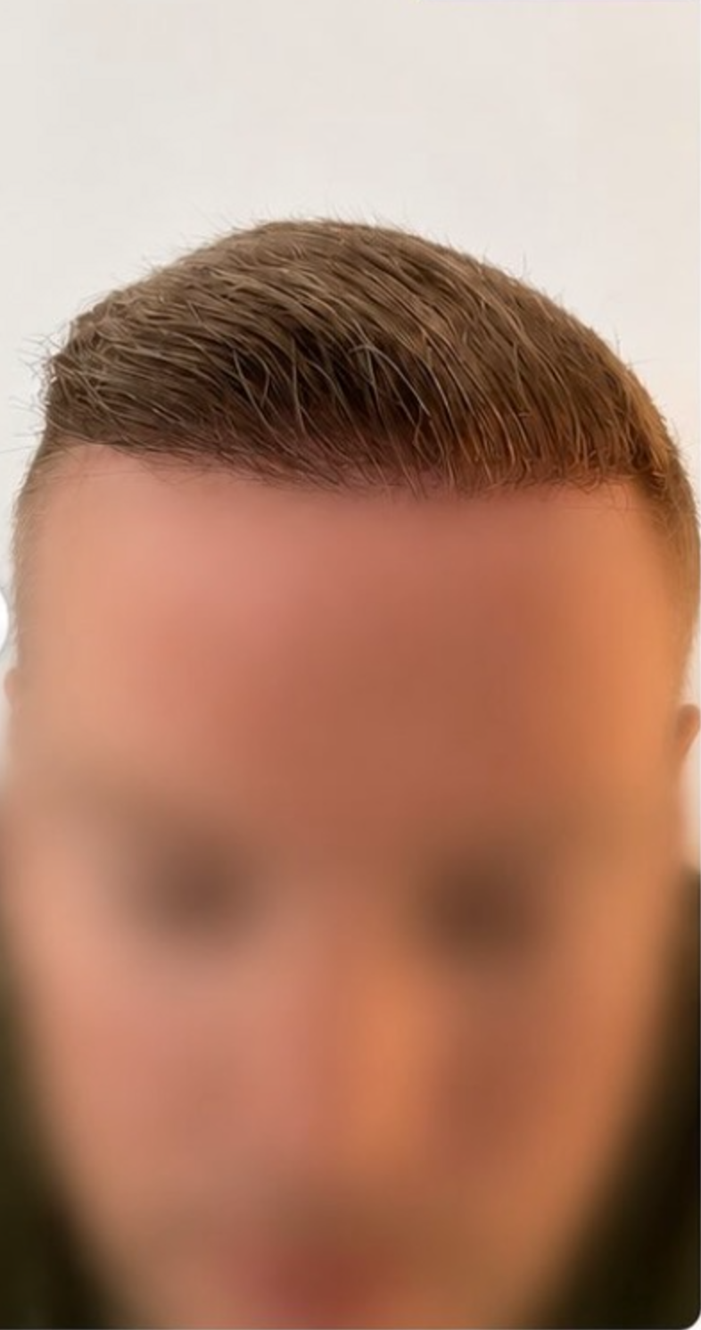 After — Frontal Hairline