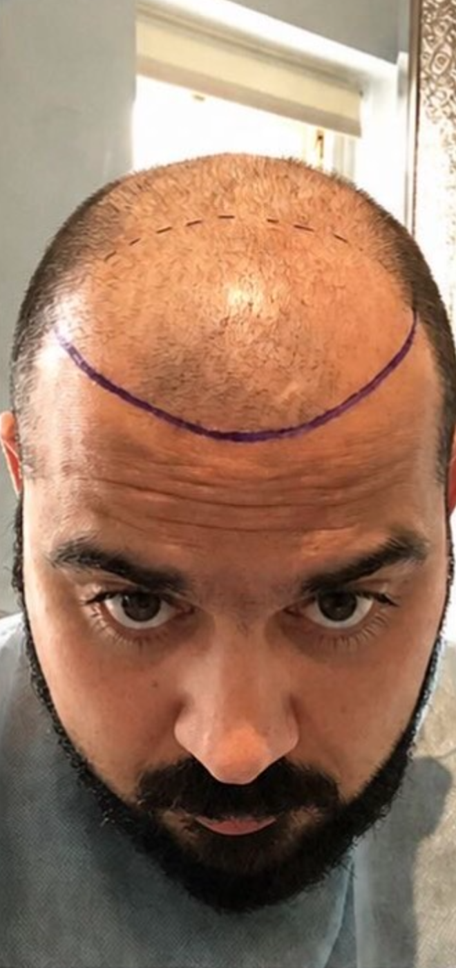 Before — Hairline Reconstruction