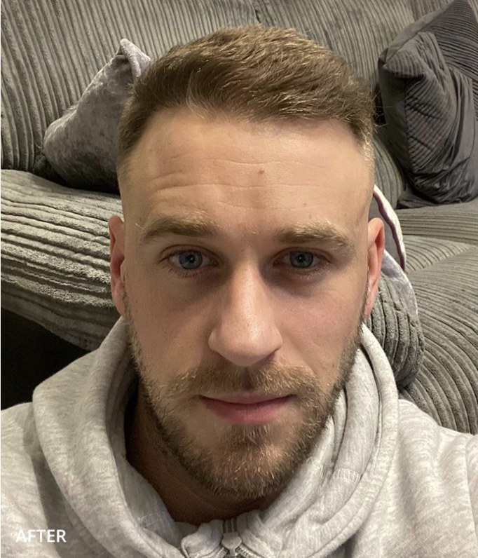 After hair transplant
