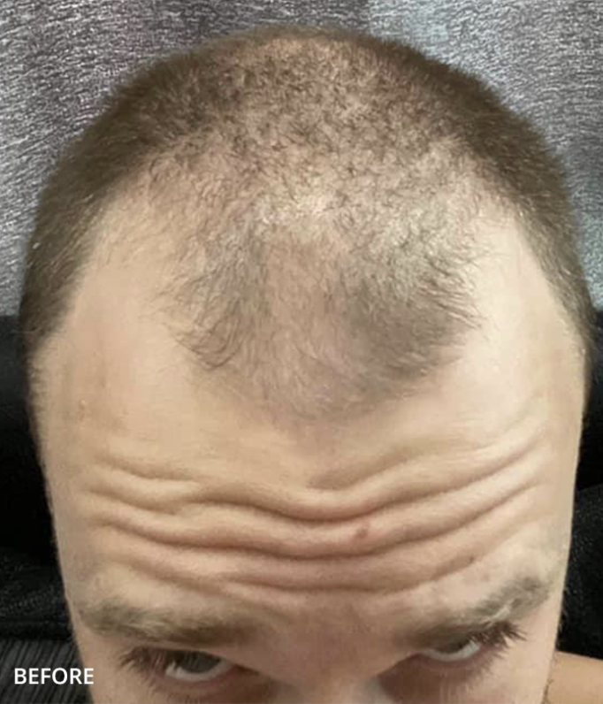 Before hair transplant