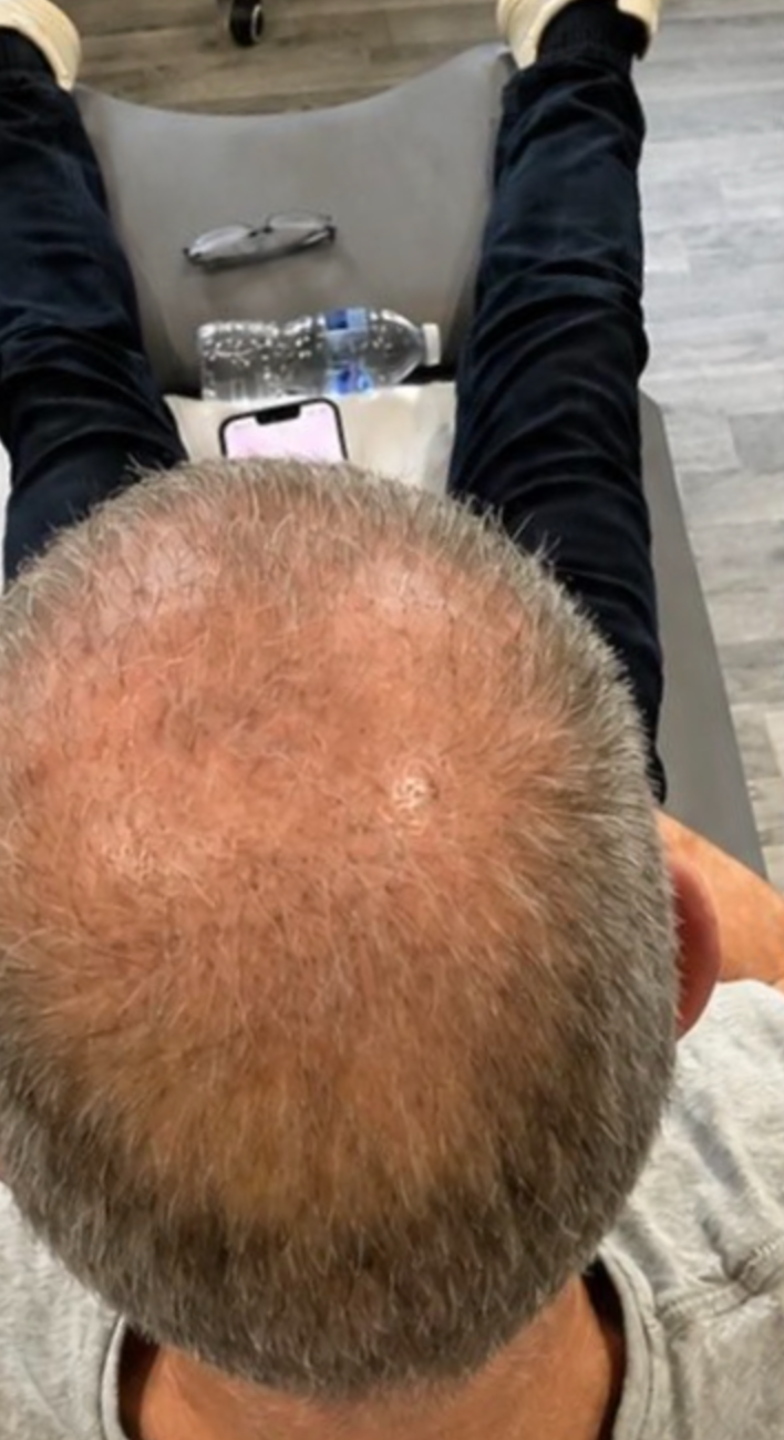 Before - Crown