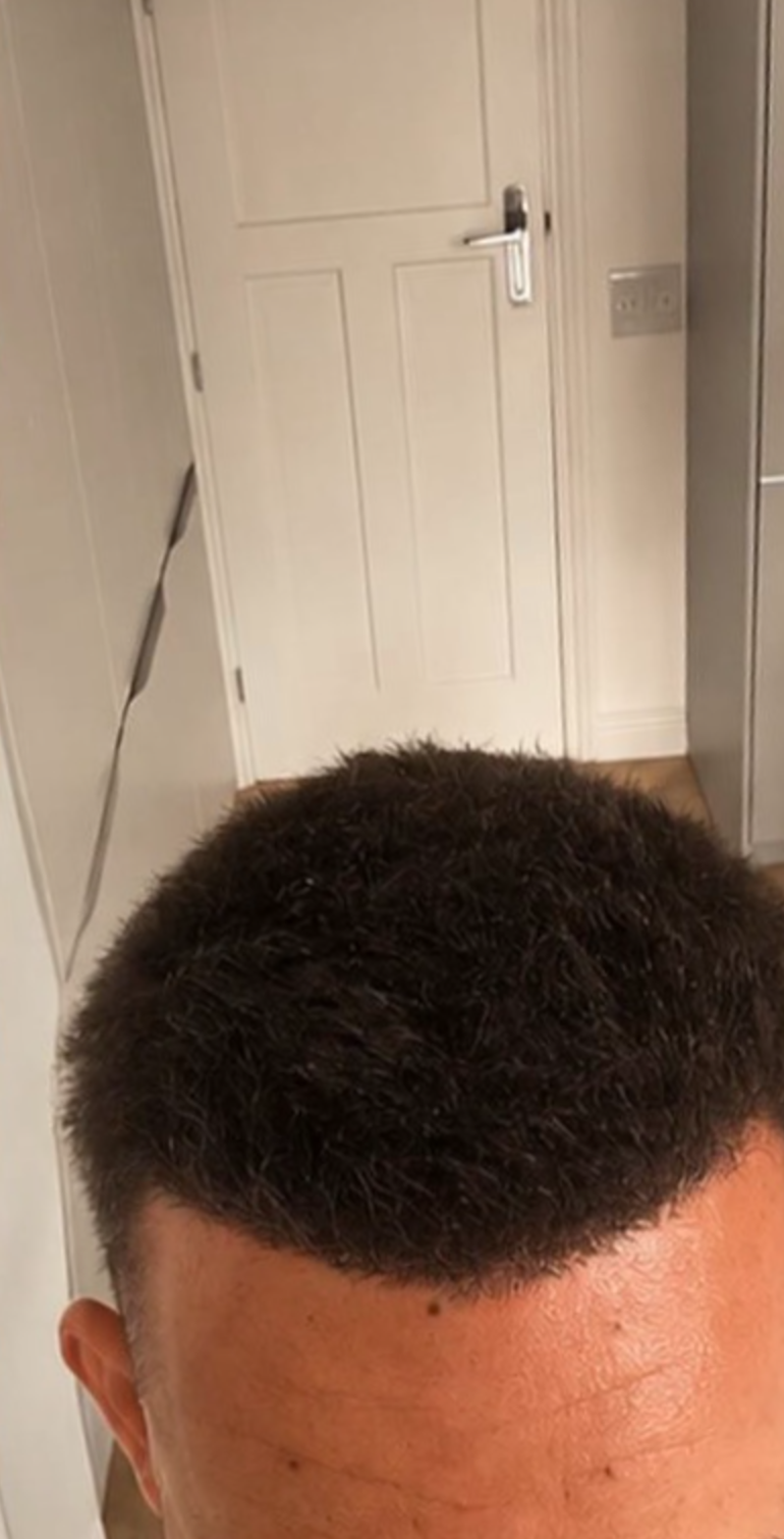 After — Hairline & Temples