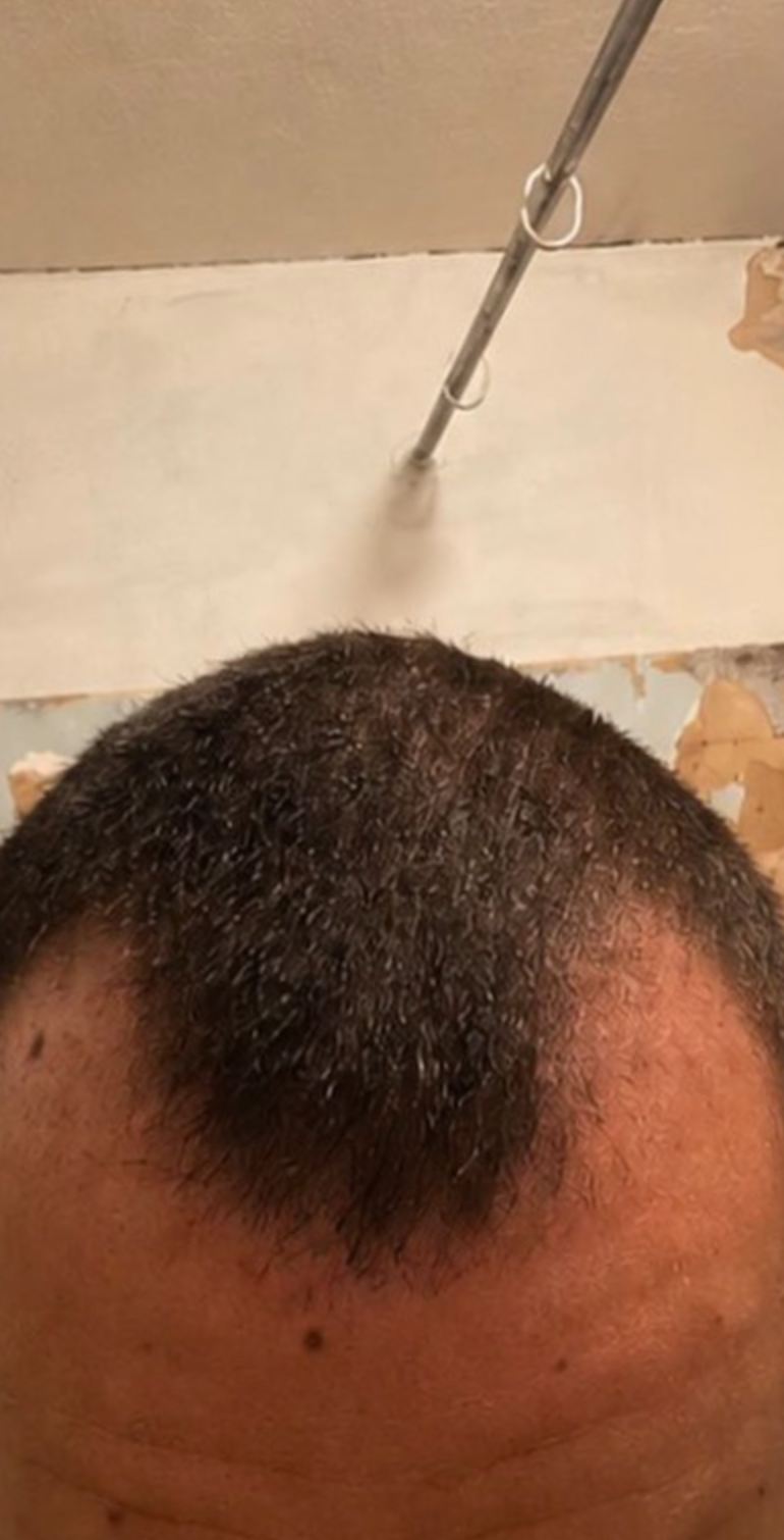 Before — Hairline & Temples