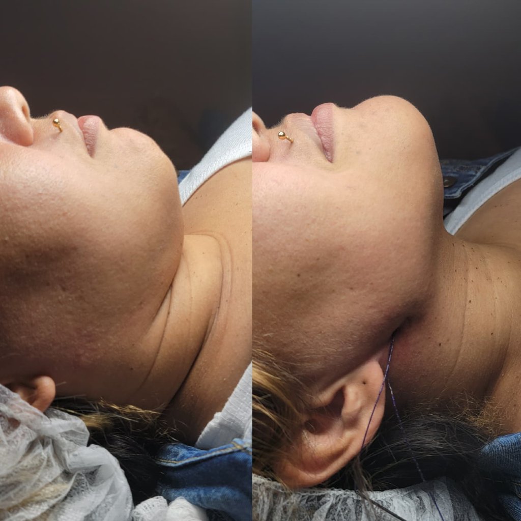 Hilo Tensor Mandibular