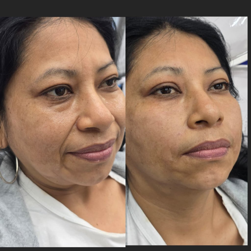 Relleno Nasogeniano — Antes y Después