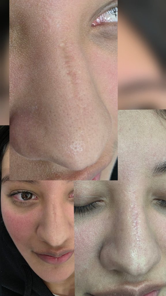 Tratamiento de Cicatriz Nasal — Antes y Después
