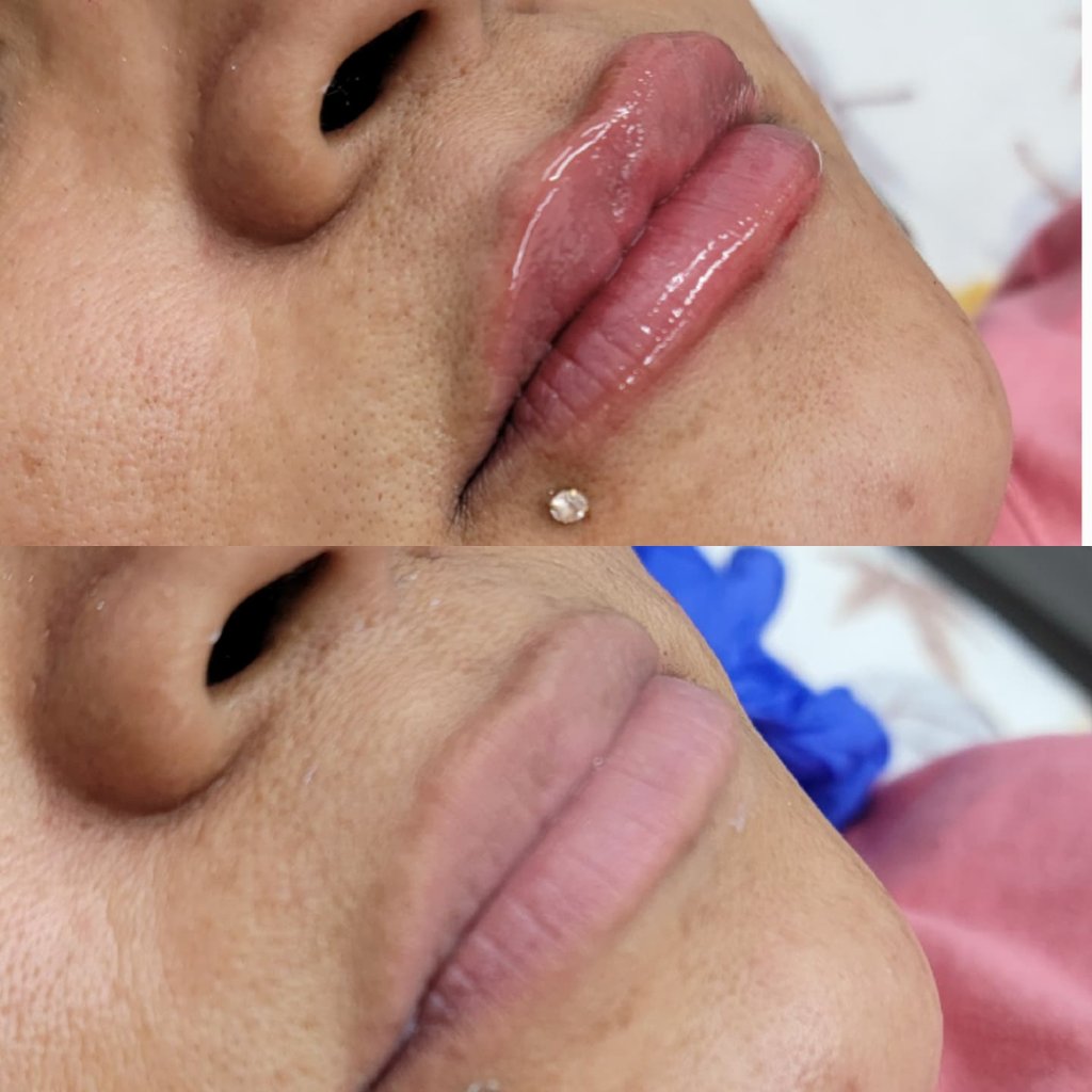 Aumento de Labios