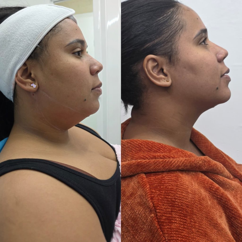 Perfilado de Mandíbula