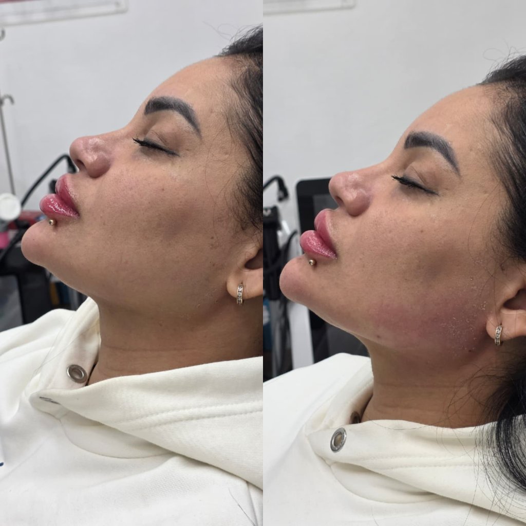 Tratamiento de Contorno Mandibular