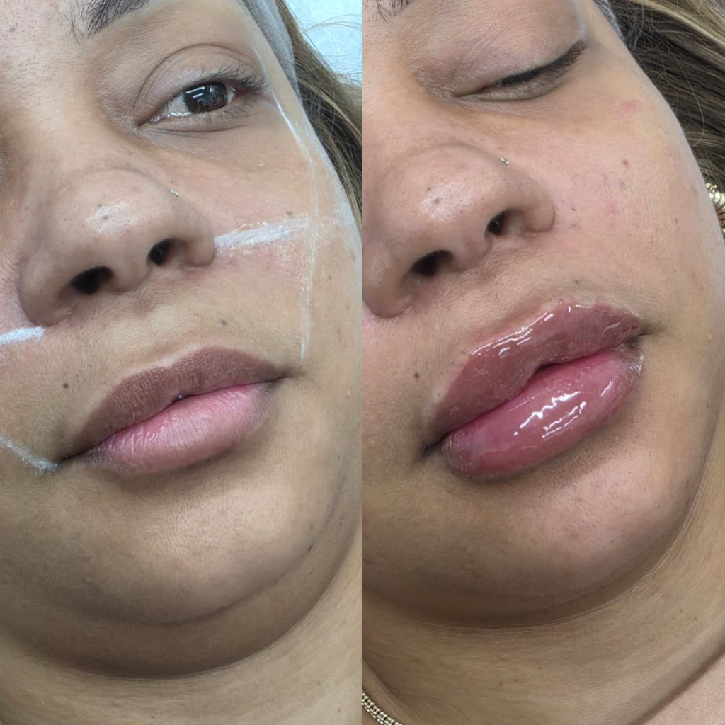 Aumento de Labios — Antes y Después