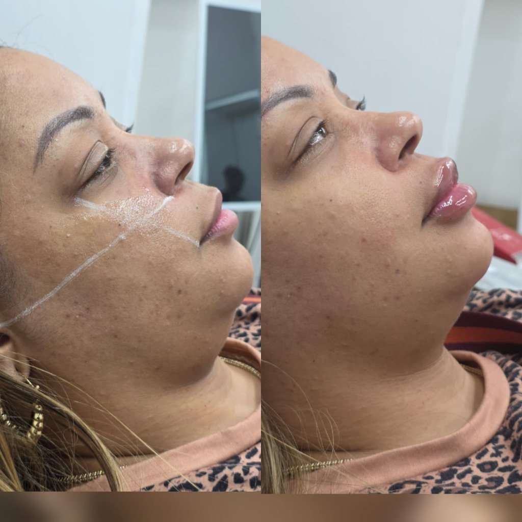 Relleno Labial con Marcación — Antes y Después