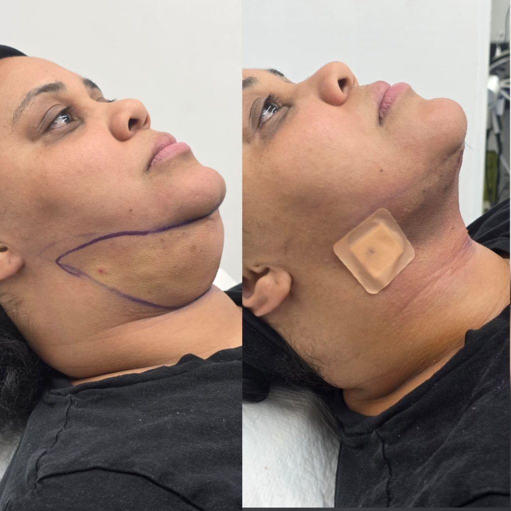 Lipólisis Submental — Antes y Después