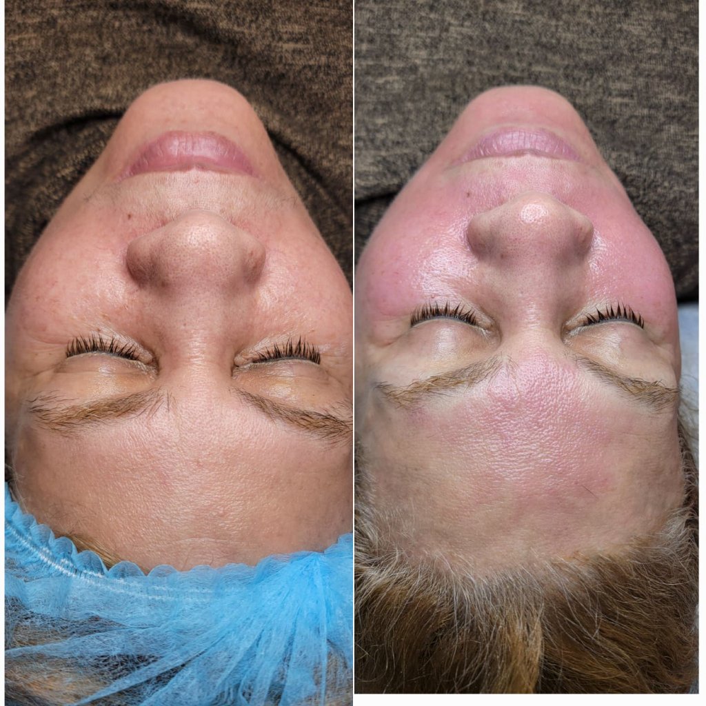 Rejuvenecimiento Facial con Peeling Químico