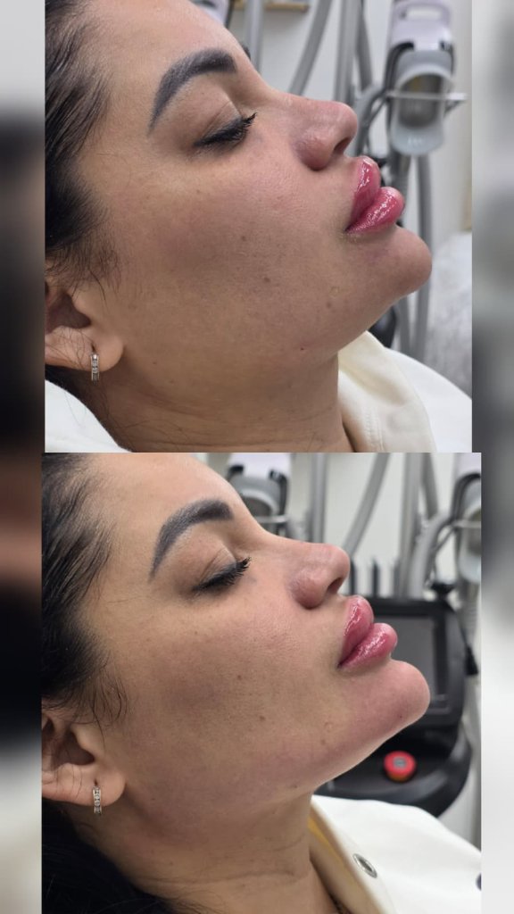 Relleno de Labios