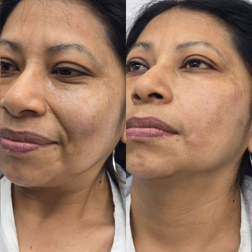 Definición Facial — Antes y Después