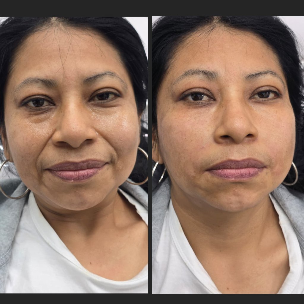 Rellenos Faciales — Antes y Después