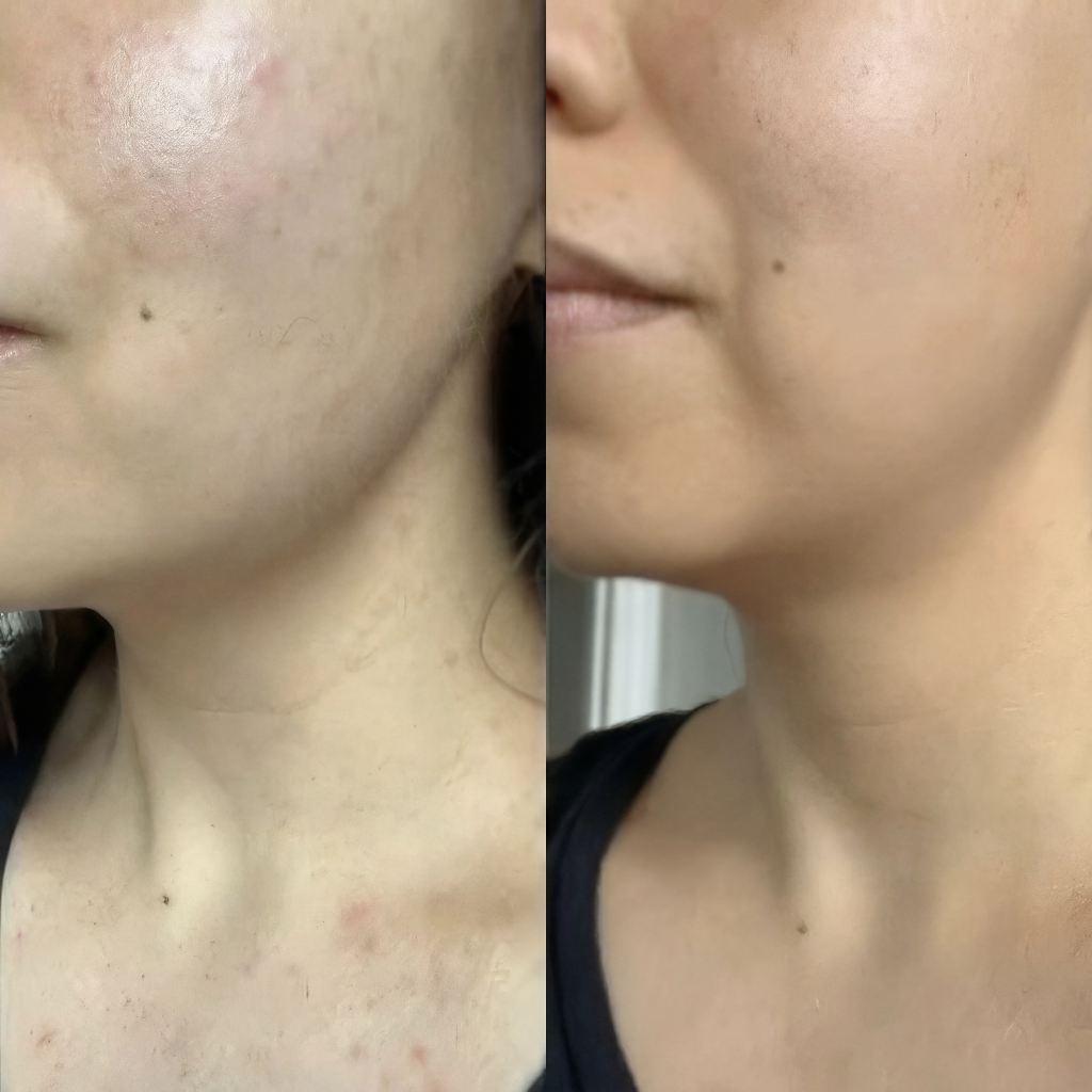 Antes e depois