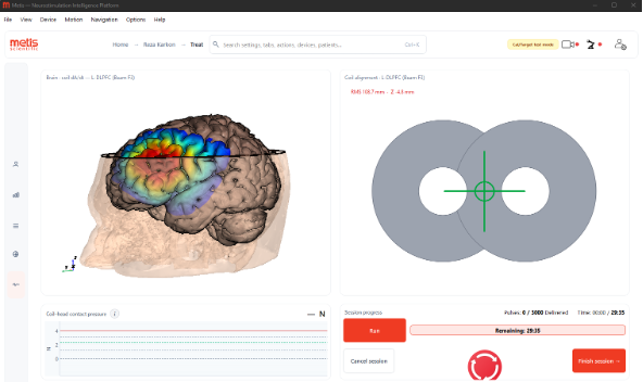 Orion Treat screen — 3D stimulation field, coil alignment, contact pressure and session progress