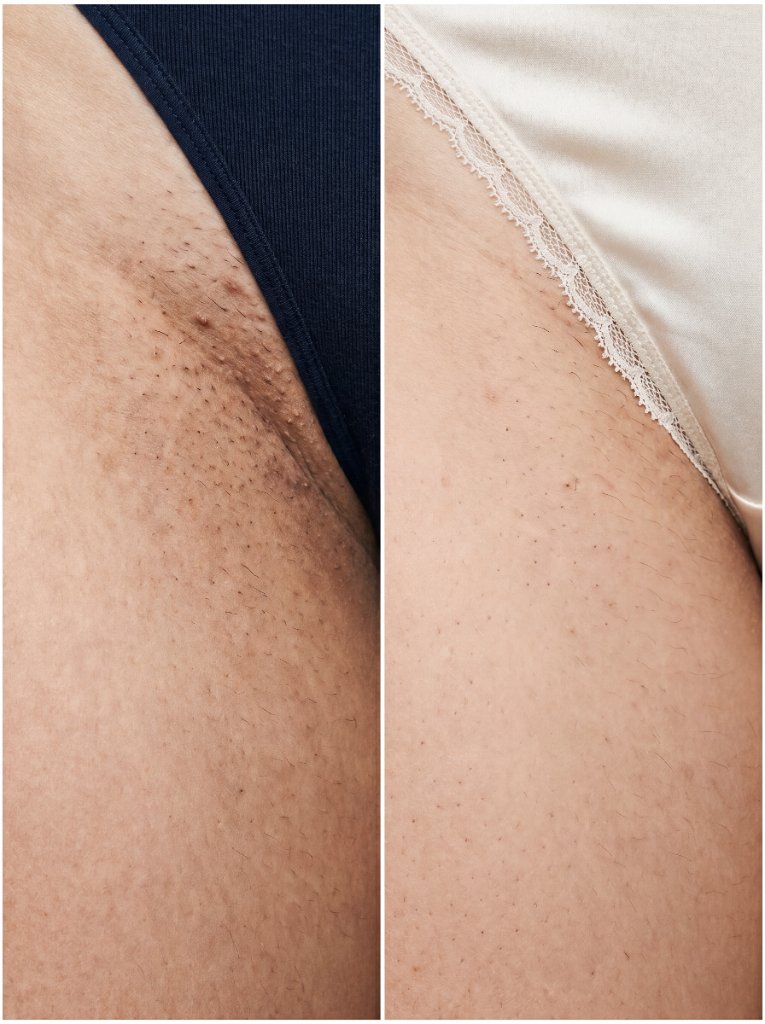 Virilha — 6 semanas