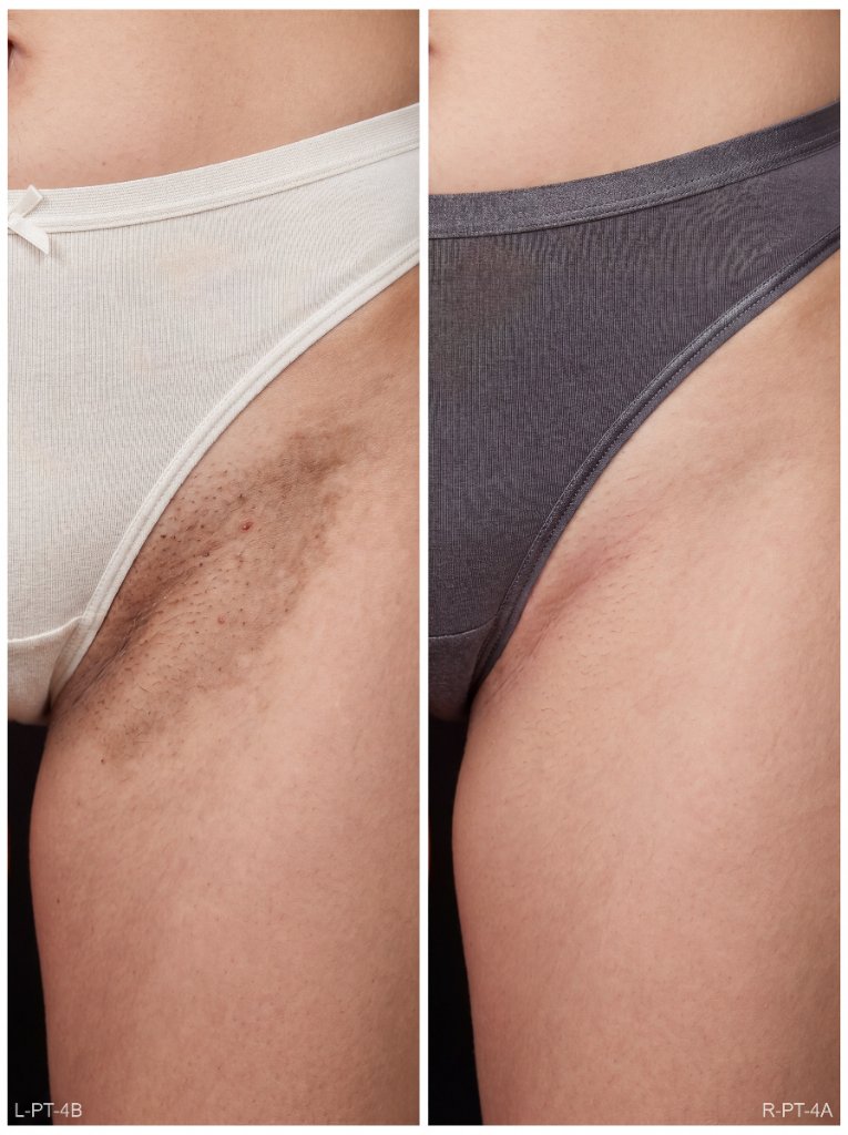 Antes e depois — Virilha