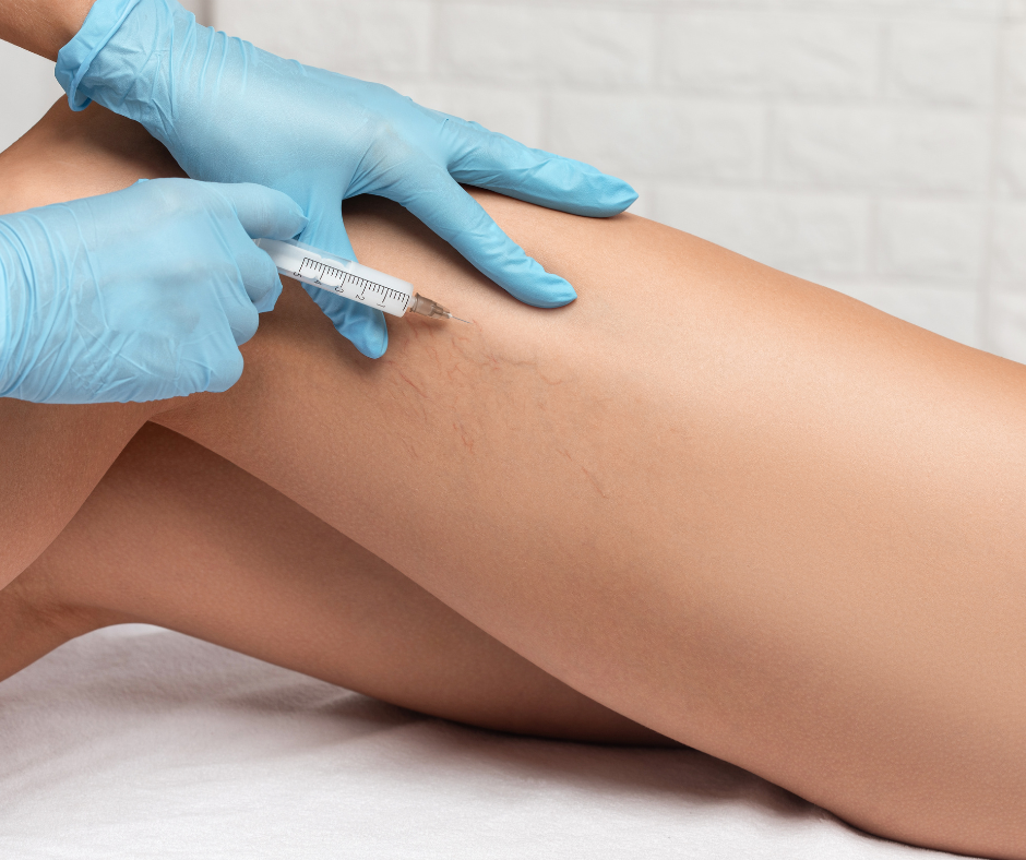 Sclerotherapy